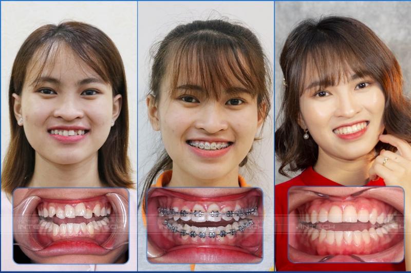 Sự thay đổi của Khách hàng sau khi niềng răng tại Lạc Việt Intech