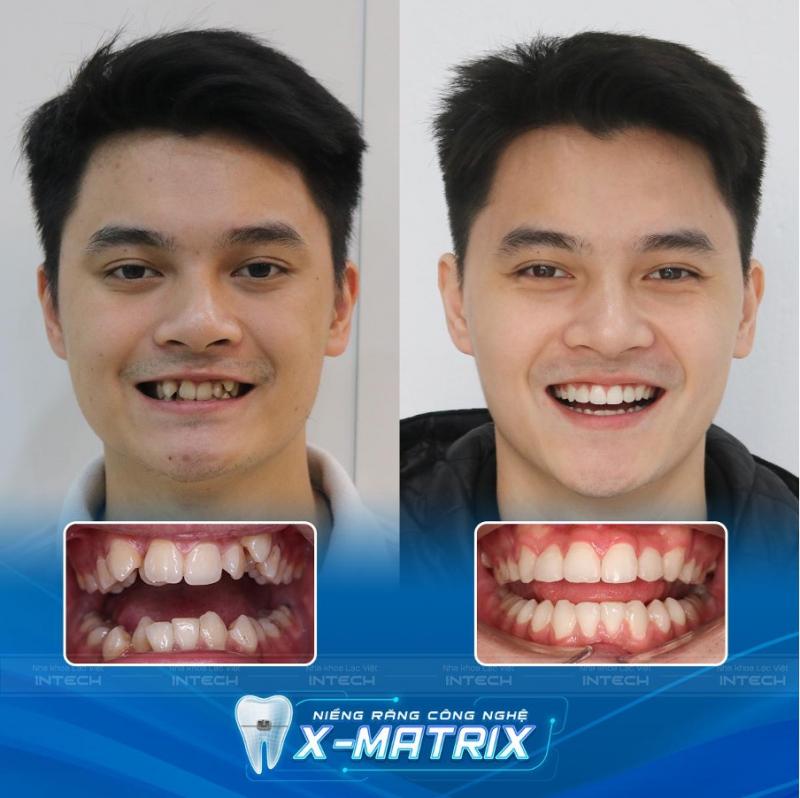 Khách hàng sau khi niềng răng bằng công nghệ X- Matrix