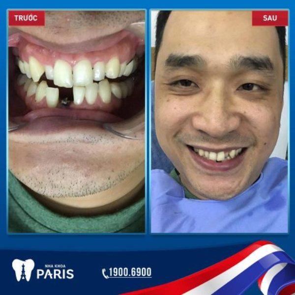 Hình ảnh khách hàng trồng răng Impland tại nha khoa Paris Đà Nẵng