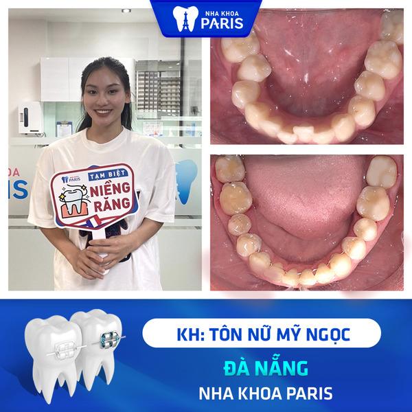 Trước và sau khi niềng răng tại nha khoa Paris