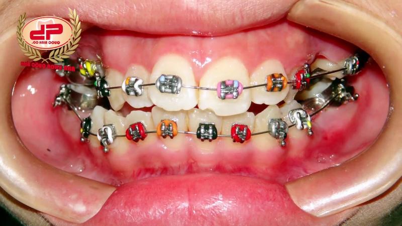 Kết quả điều trị niềng răng sau 2 năm - Nha khoa Quốc Bình Vũng Tàu