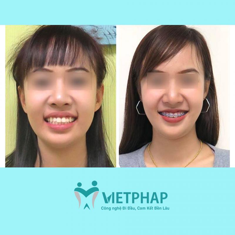 Khách hàng trước và sau bọc răng sứ tại Việt Pháp