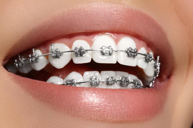 Sau một thời gian điều trị niềng răng tại Nha khoa Việt Hàn khách hàng sở hữu hàm răng như ý