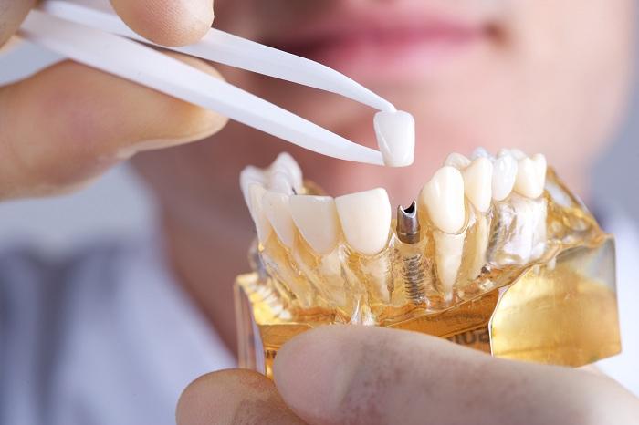 Dịch vụ trồng răng Implant tại Nha khoa Việt Pháp