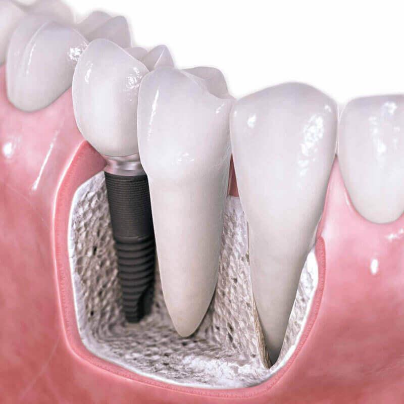 Bác sĩ phẫu thuật răng implant tại Quảng Ngãi được công nhận như thế nào?
