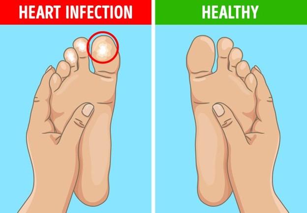 Nổi cục gây đau ở ngón tay và ngón chân của bạn