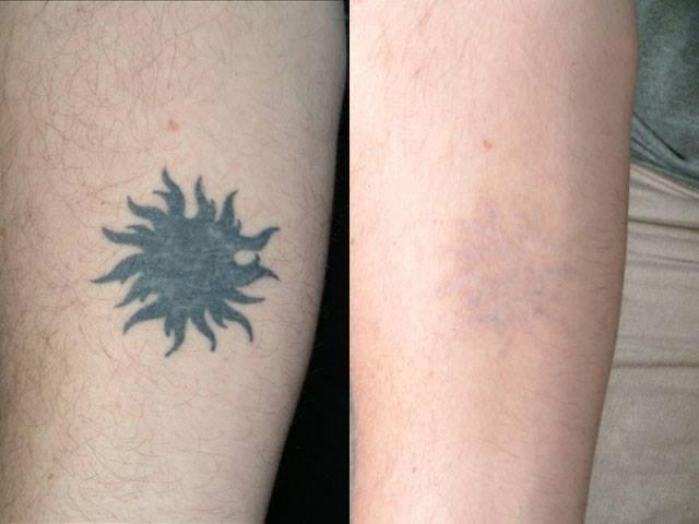 Orion tatoo xóa hình xăm an toàn không để lại sẹo