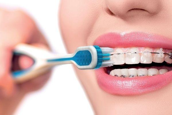 Quá trình chăm sóc răng miệng trong quá trình niềng