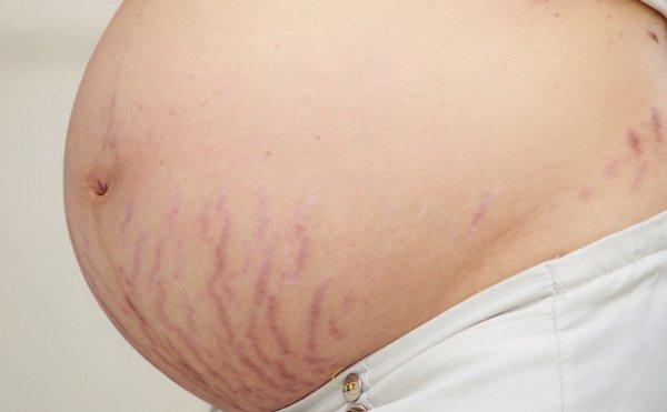 Rạn da cũng là một trong những vấn đề phổ biến khi mang thai