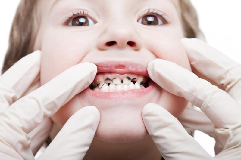 Trẻ chậm mọc răng hay sâu răng