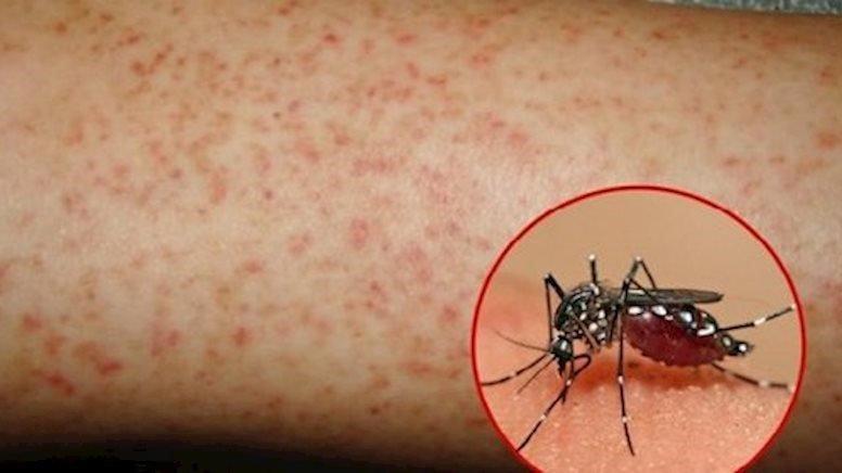 Sốt xuất huyết là bệnh truyền nhiễm lây truyền bởi muỗi vằn