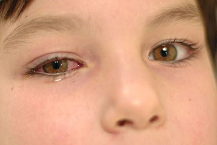 Sử dụng nhiều loại dung dịch nhỏ mắt một lúc có thể gây nóng rát mắt, chảy nước mắt