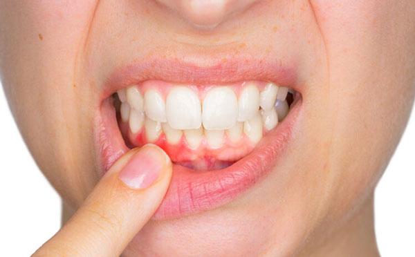 Răng giả tháo lắp kém chất lượng có thể gây viêm nướu