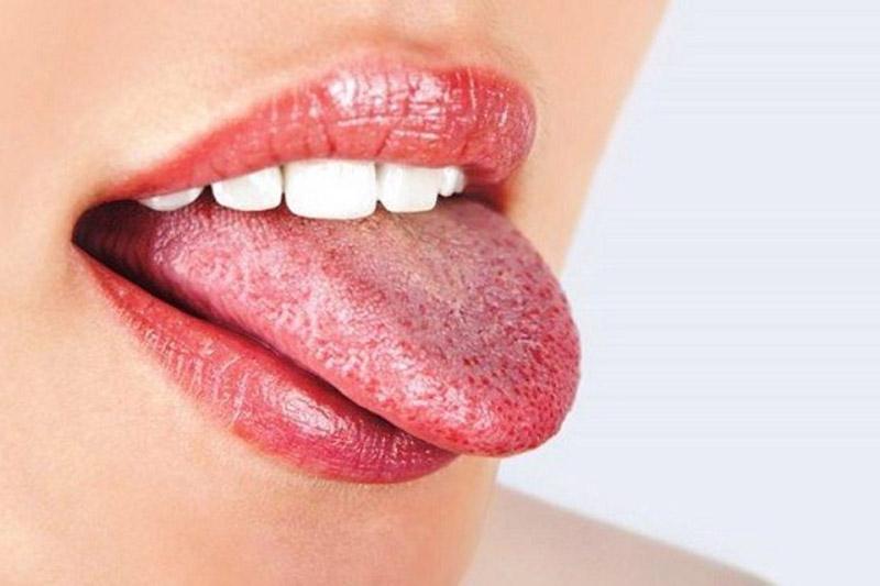 Bệnh nấm Candida ở miệng và ở họng (chứng tưa) xảy ra ở một vài bệnh nhân