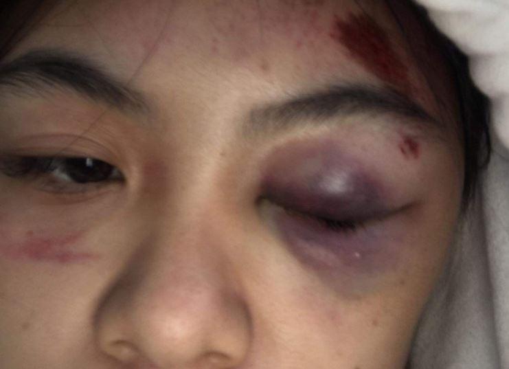 Nữ sinh bị đánh bầm tím ở mắt. (Ảnh: vnexpress)