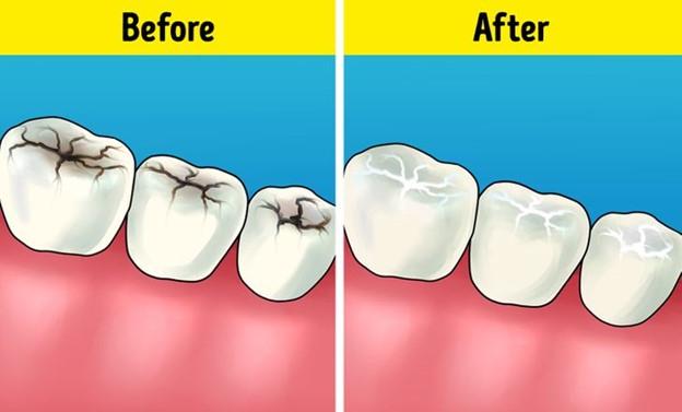 Tất cả các khe nứt trên răng là gì và tại sao chúng ta cần phải trám chúng?