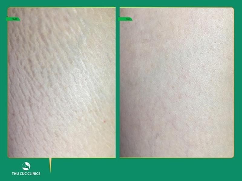 Kết quả trước và sau điều trị rạn da tại Thu Cúc