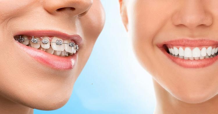 Ưu điểm và hạn chế của niềng răng mắc cài kim loại