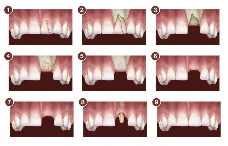 Mô phỏng kỹ thuật cấy xương trong trồng răng Implant