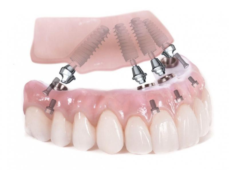 Trồng răng implant toàn hàm All-on-4