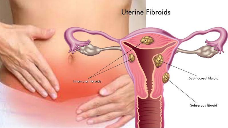 U xơ tử cung là bệnh lý phụ khoa phổ biến ở mọi độ tuổi, nhất là phụ nữ trong giai đoạn sinh đẻ, đang mang thai hoặc mãn kinh