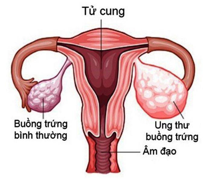 Những bất thường của buồng trứng nữ giới khi bị ung thư