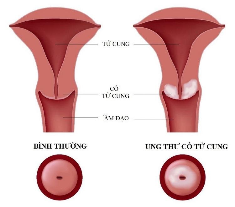 So sánh giữa cổ tử cung bình thường và cổ tử cung bị ung thư