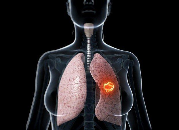 Ung thư phổi là bệnh ung thư phổ biến nhất ảnh hưởng đến cả nam lẫn nữ