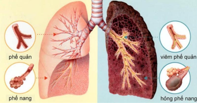 Hình ảnh lá phổi ung thư (bên phải) và lá phổi lành (bên trái)
