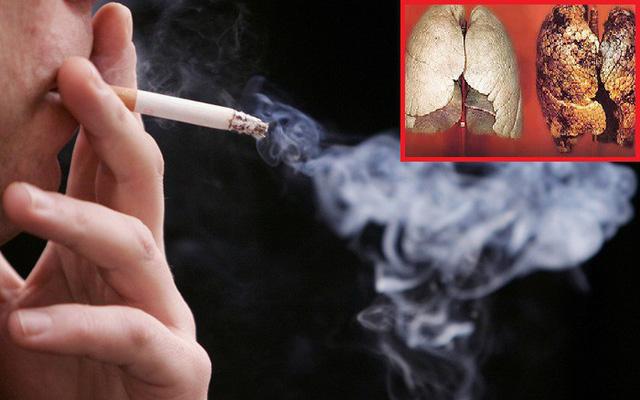 Hút thuốc lá gây ung thư phổi
