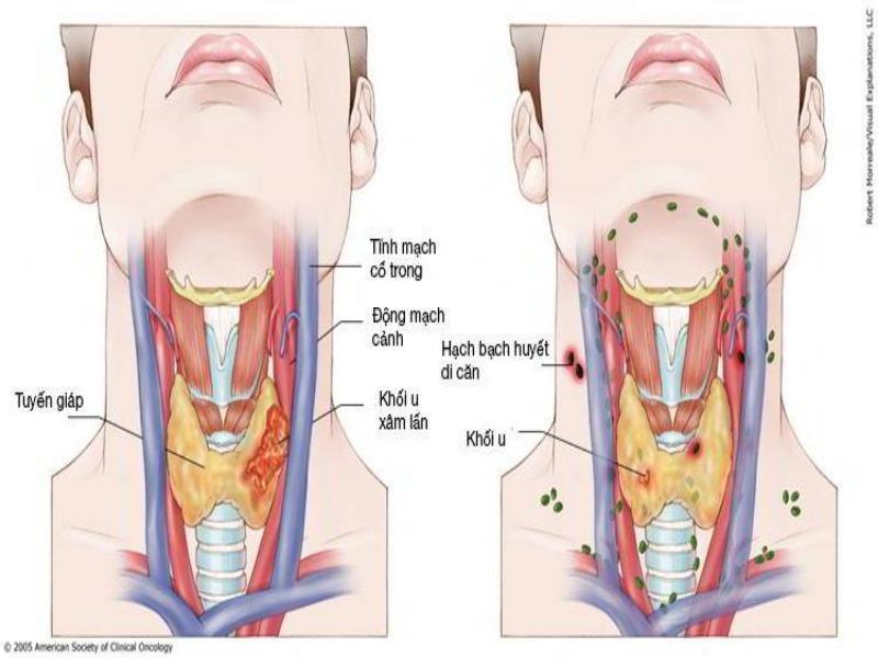 Ung thư vòm họng là bệnh đứng hàng đầu trong các loại ung thư vùng đầu mặt cổ