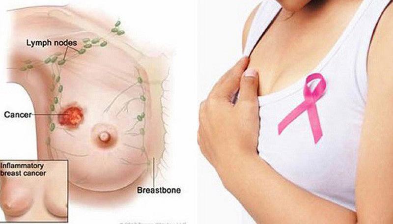 Ung thư vú ở phụ nữ là căn bệnh phổ biến nhất mà rất nhiều chị em phải đối mặt