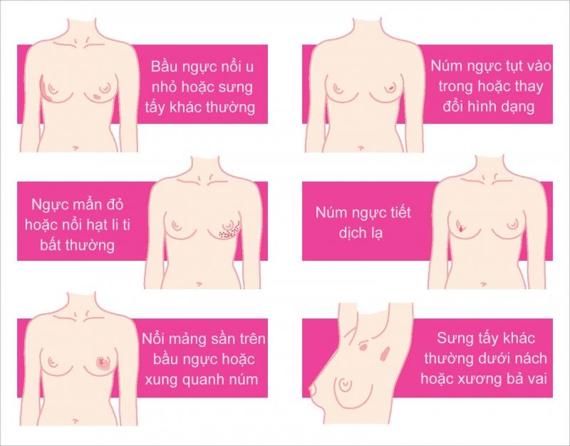 Minh họa cho các dấu hiệu của bệnh ung thư vú