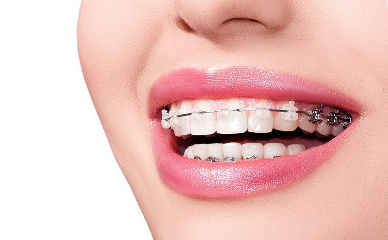 Ưu điểm và hạn chế của niềng răng bằng vật liệu 3M