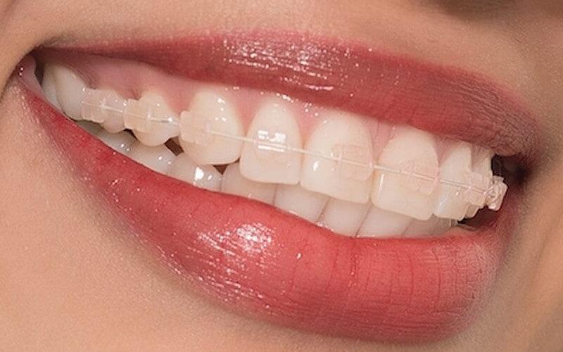 Ưu điểm và hạn chế của niềng răng mắc cài sứ dây trong