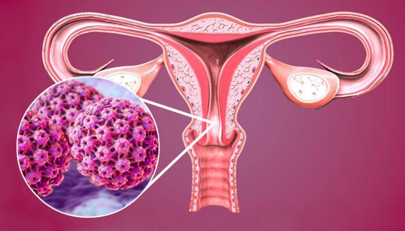 Virus HPV gây ung thư cổ tử cung