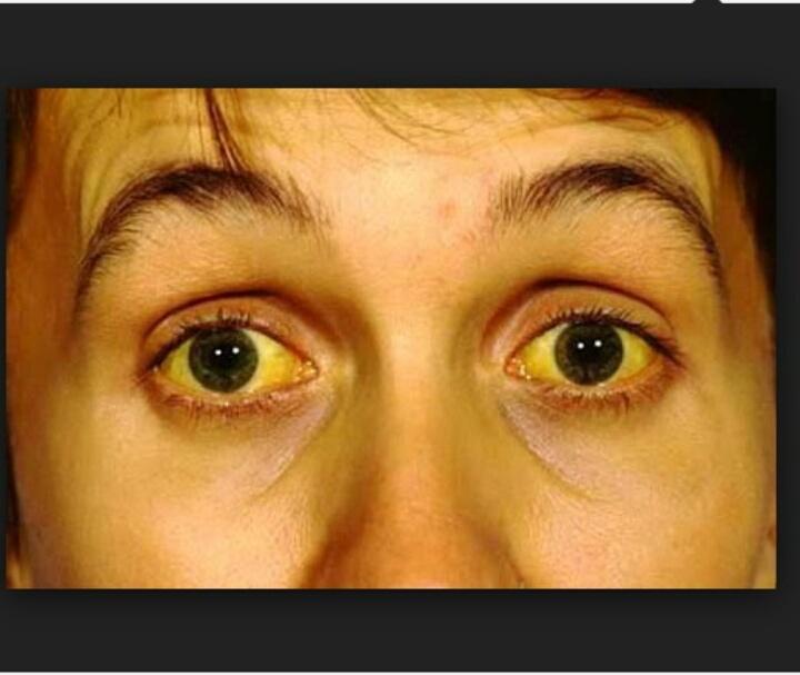 Vàng mắt - dấu hiệu cảnh báo viêm gan B điển hình