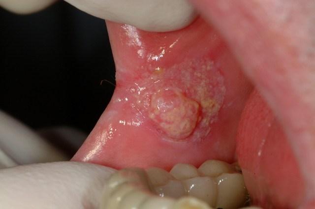 Xuất hiện đốm trắng hay màu đỏ trên nướu răng hoặc lưỡi thì có thể là dấu hiệu của bệnh ung thư miệng.