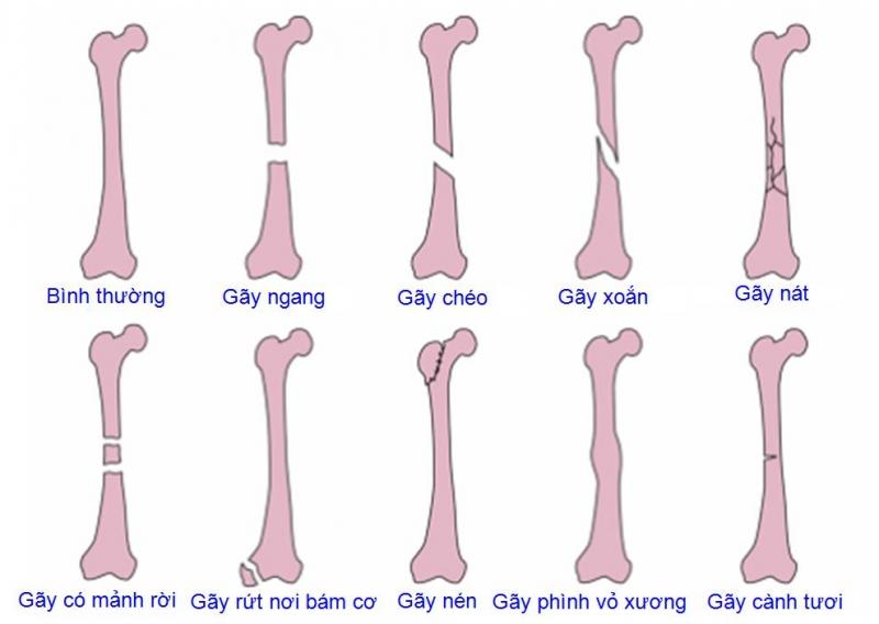 Các biểu hiện của gãy xương
