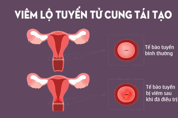 Viêm lộ tuyến cổ tử cung là bệnh phụ khoa nhiều chị em phụ nữ mắc phải