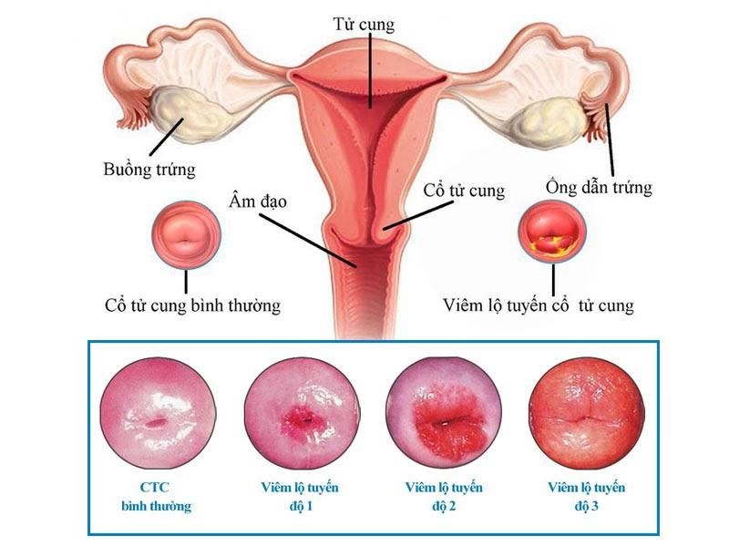 Viêm lộ tuyến tử cung là bệnh gì?