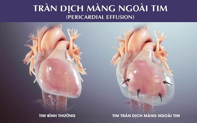 Tràn dịch ngoài màng tim - một trong những biến chứng của viêm màng phổi