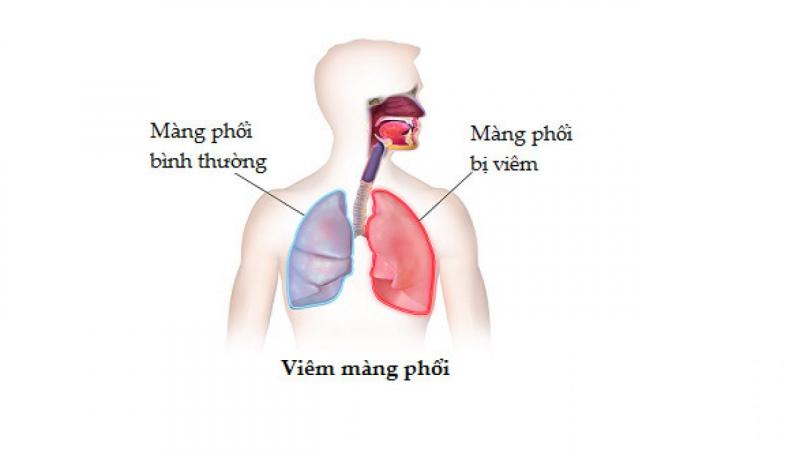 Viêm màng phổi là bệnh gì?