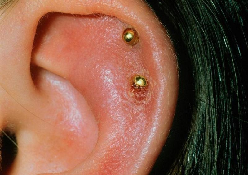 Xỏ khuyên tai quá lớn, nhiều có thể gây hại cho tai